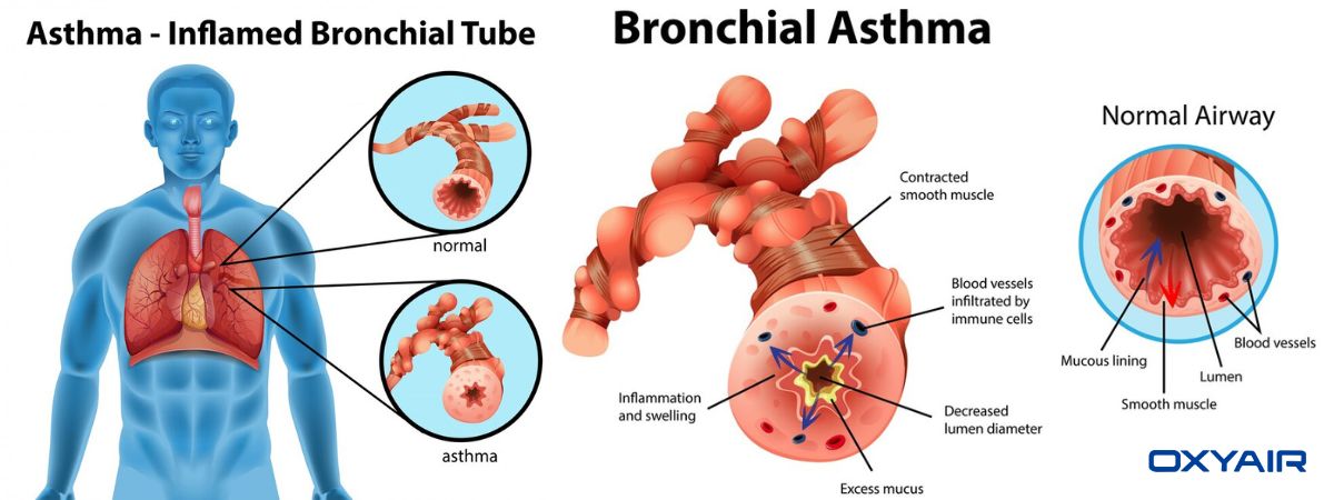 Is hyperbaric chamber good for asthma